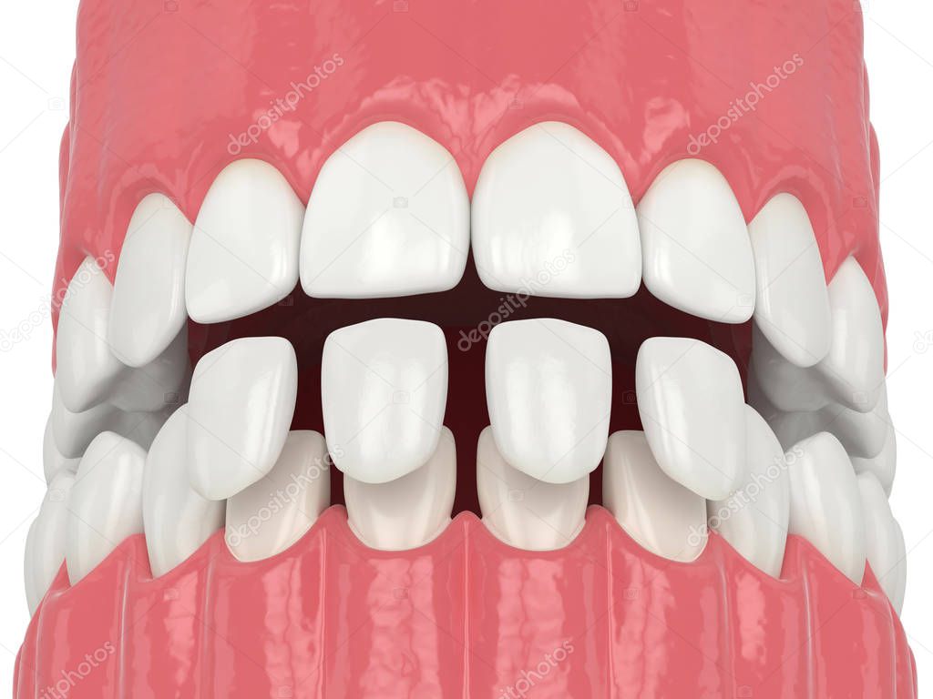 3d render of jaw with lower veneers
