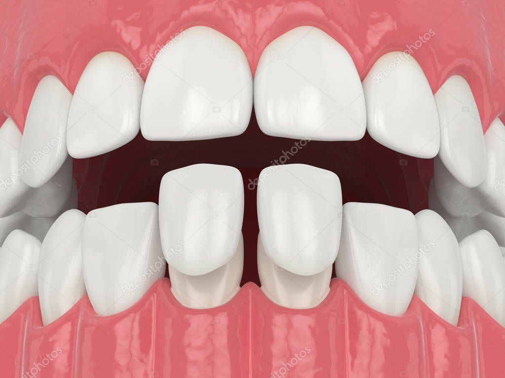 3d render of jaw with lower veneers