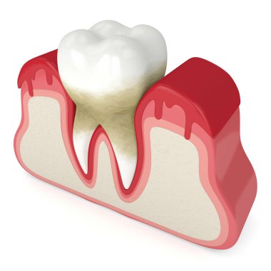 3d render of tooth in bleeding gums clipart