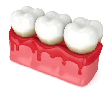 3d render of teeth in bleeding gums clipart