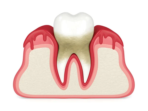 3d визуализация зуба в кровоточащих деснах — стоковое фото