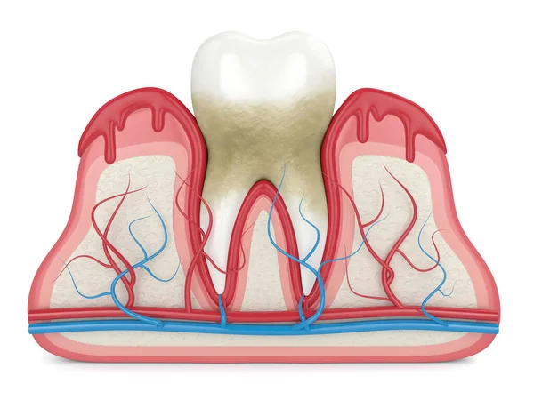 Rendering 3d dei denti nelle gengive sanguinanti — Foto Stock