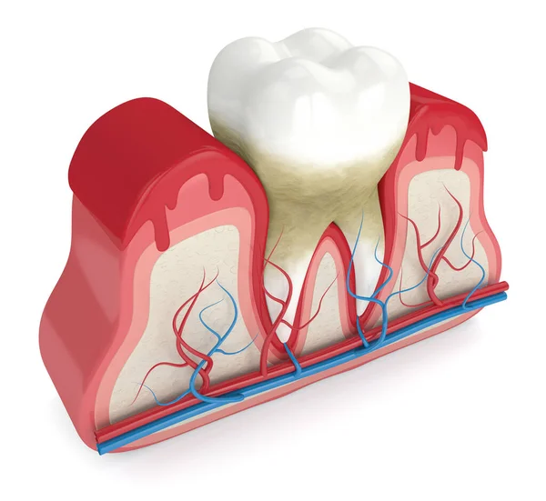 3d renderizado de dientes en encías sangrantes — Foto de Stock