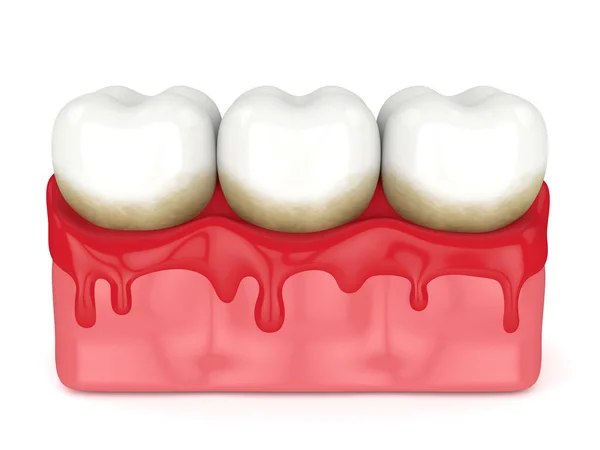 3d renderização de dentes em sangramento gengivas — Fotografia de Stock