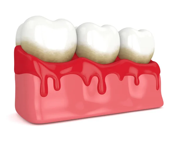 3d renderização de dentes em sangramento gengivas — Fotografia de Stock