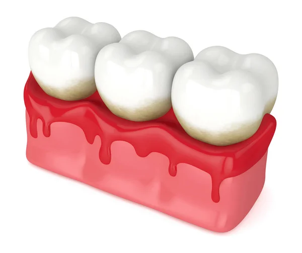 잇몸 출혈 이 있는 치아를 3D 로 만들어 주는 방법 — 스톡 사진