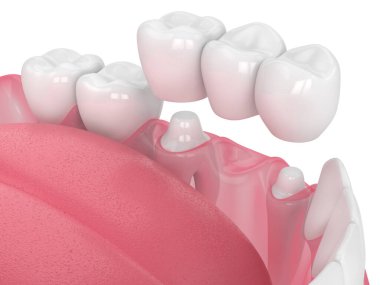 çene diş köprü ile 3D render