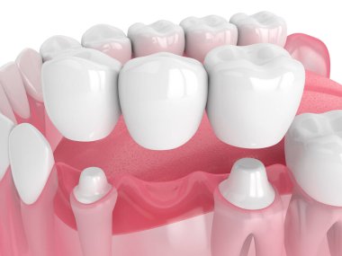 3d render of jaw with dental bridge clipart