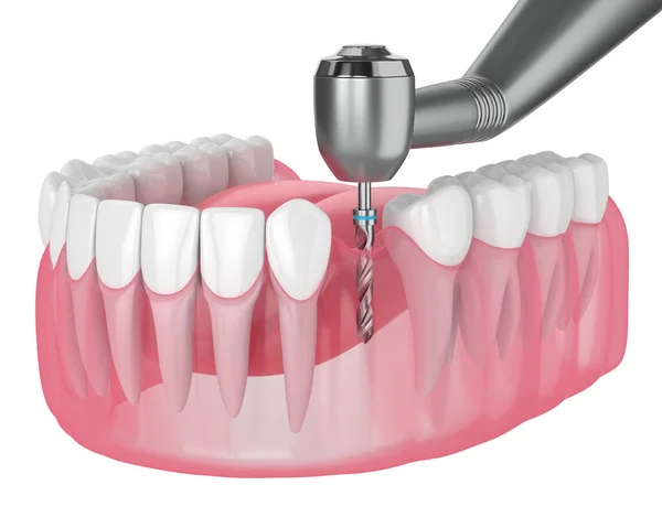3d återgivning av käke med tandköttsborrning — Stockfoto