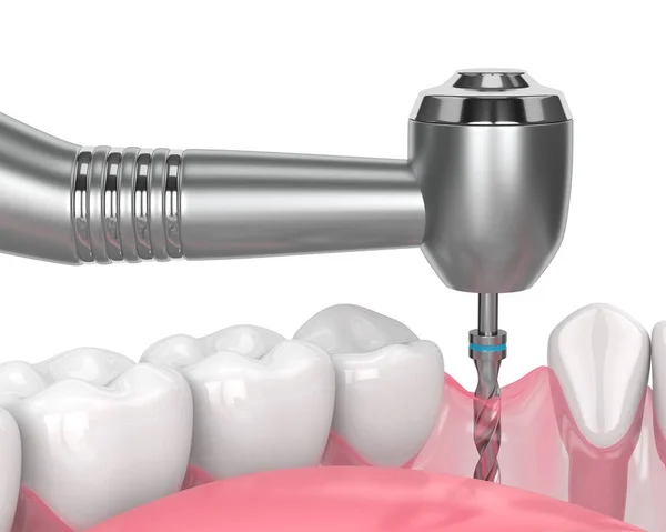 3d render of jaw with gum drilling — ストック写真