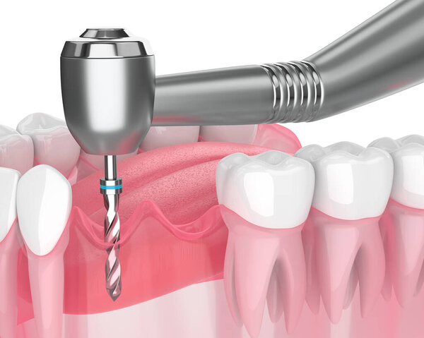 3D рендеринг челюсти с резинкой сверления

