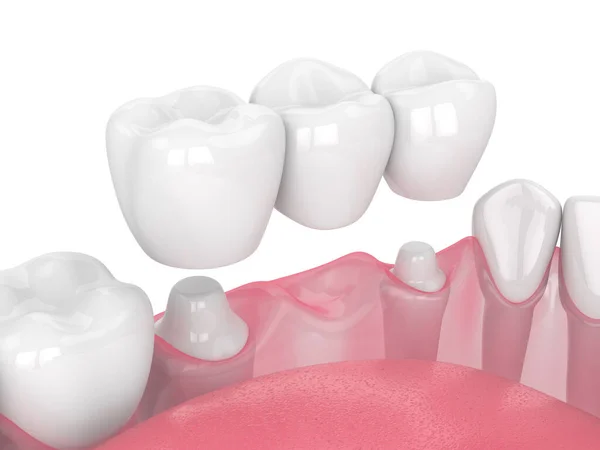 3d render of jaw with dental bridge — Stock Photo, Image