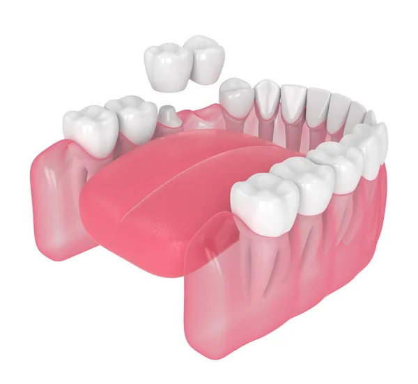 3d renderizado de mandíbula con puente en voladizo dental —  Fotos de Stock