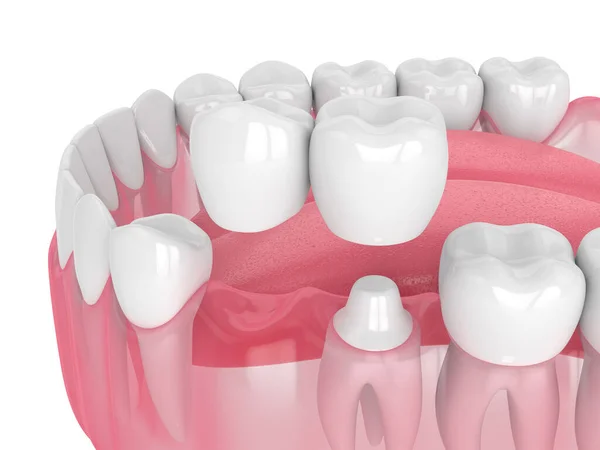 3D render szczęki z dentystyczne mostu wspornikowego — Zdjęcie stockowe