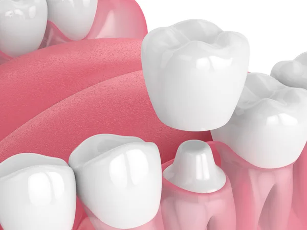 3d renderização da mandíbula com dentes e restauração coroa dental — Fotografia de Stock