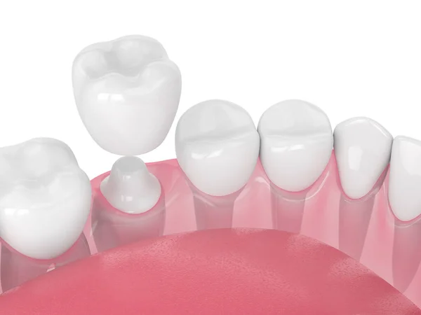 3d render of jaw with teeth and dental crown restoration — Stock Photo, Image