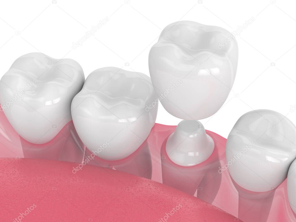 3d render of jaw with teeth and dental crown restoration