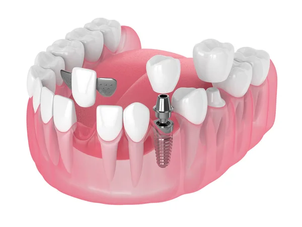 3d renderização da mandíbula com implantes dentários e pontes sobre branco — Fotografia de Stock