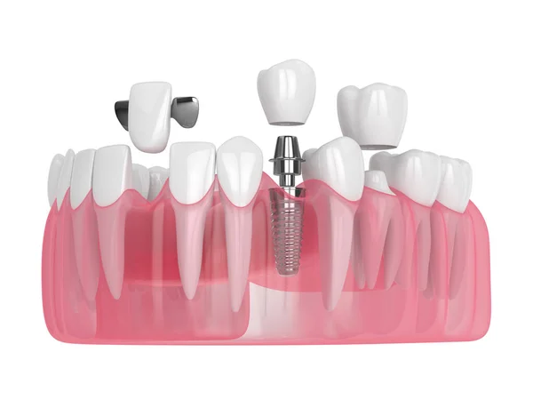 3d renderizado de mandíbula con implantes dentales y puentes sobre blanco — Foto de Stock