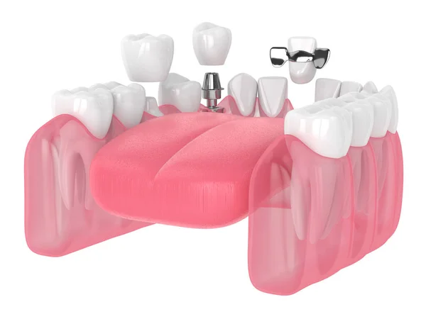 3d renderização da mandíbula com implantes dentários e pontes sobre branco — Fotografia de Stock