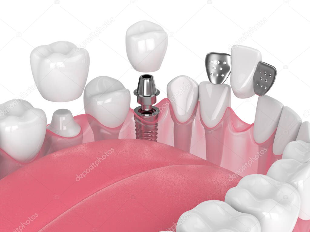 3d render of jaw with dental implants and bridges over white