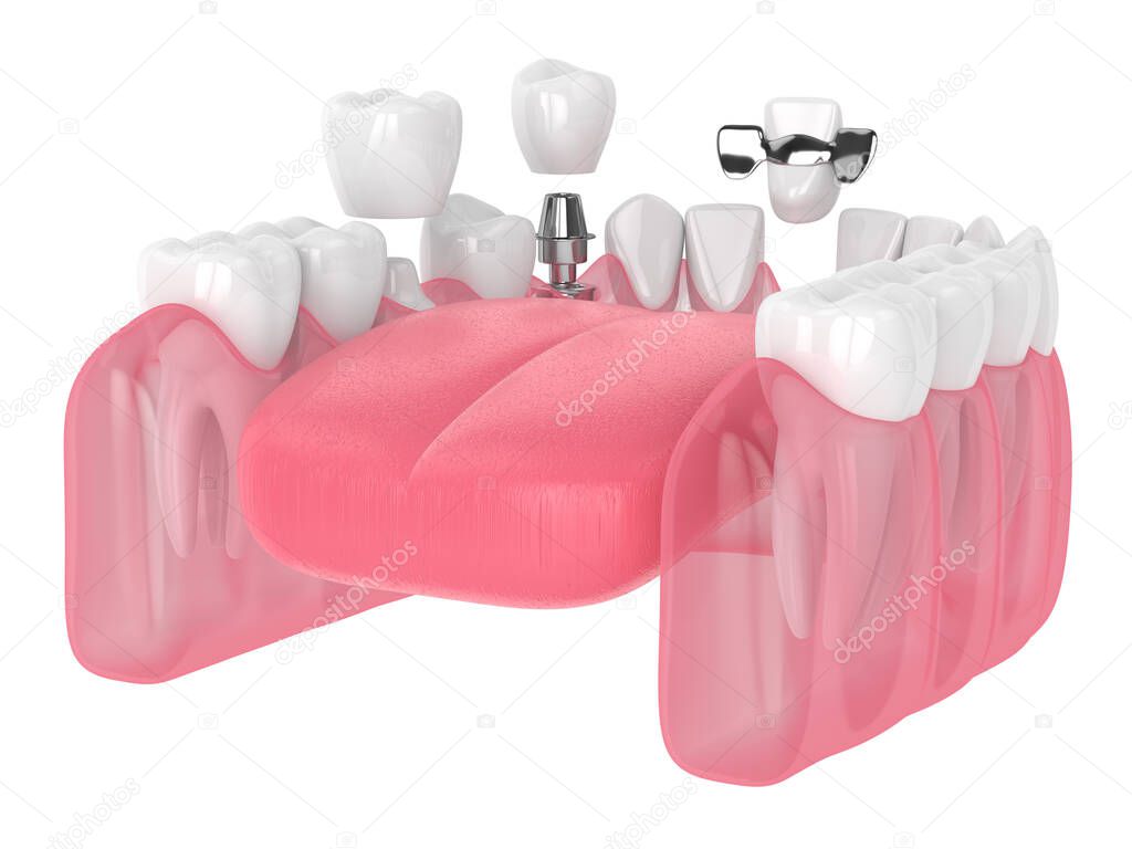 3d render of jaw with dental implants and bridges over white