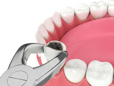 Diş kıskaçları tarafından çekilen alt çenenin 3d görüntüsü