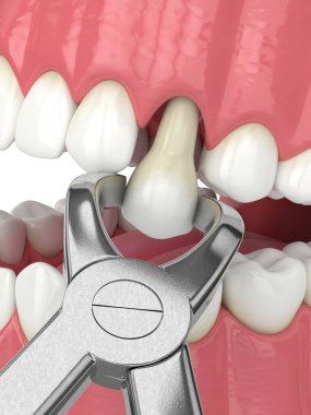 Diş kıskaçları tarafından çekilen alt çenenin 3d görüntüsü
