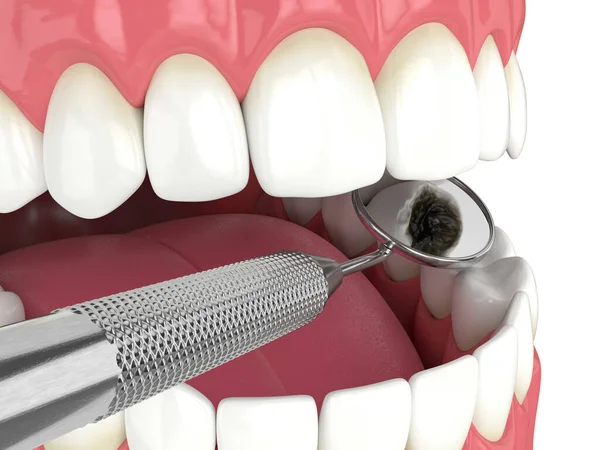 Renderowanie Szczęki Lustrem Dentystycznym Koncepcja Narzędzi Diagnostycznych Stomatologicznych — Zdjęcie stockowe