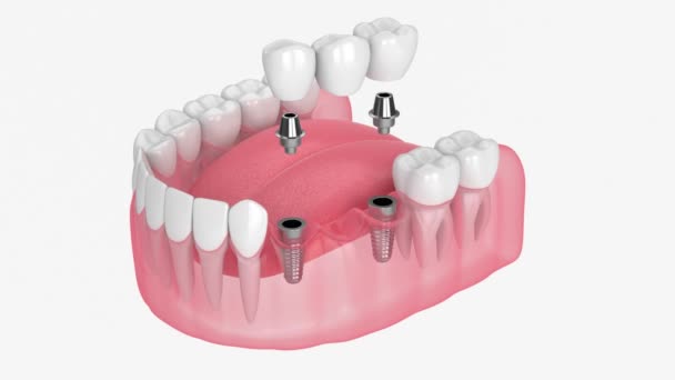 Mandíbula Con Implantes Que Soportan Puente Dental Sobre Fondo Blanco — Vídeos de Stock