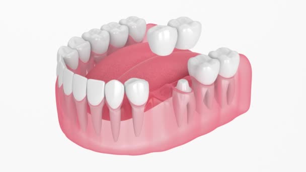 白い背景に歯のカンチレバー橋と顎 — ストック動画