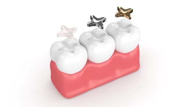 Dentes Com Diferentes Tipos Enchimento Dental Inlay — Vídeo de Stock