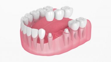 azı dişi ve azı dişleri üzerinde diş köprüsü ile çene