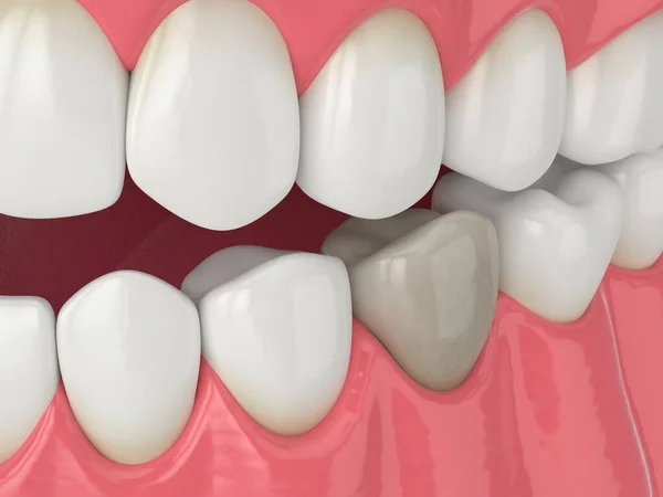 Renderização Mandíbula Dente Pré Molar Inferior Com Polpa Morta — Fotografia de Stock