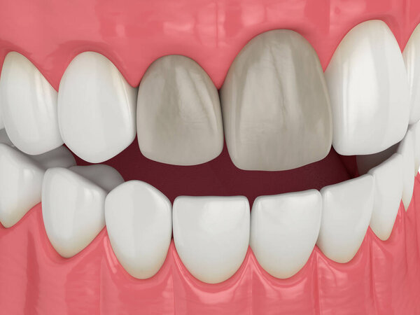 3d рендеринг челюсти и верхних зубов резца с мертвым мякотью

