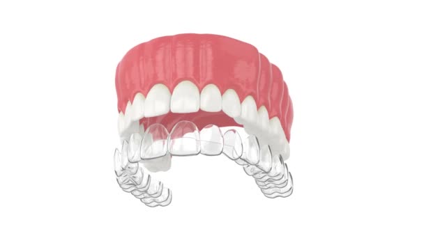 Invisalign Colocación Retenedor Extraíble Invisible Mandíbula Superior Sobre Fondo Blanco — Vídeos de Stock