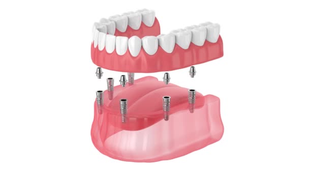 Dentadura Total Removível Implante Isolada Sobre Fundo Branco — Vídeo de Stock