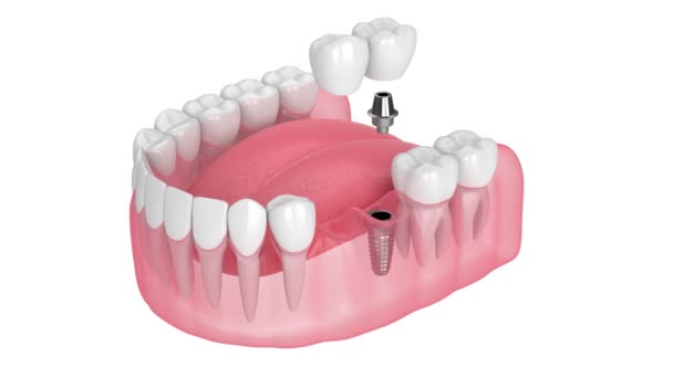 Mandíbula Con Soporte Implante Puente Voladizo Dental Aislado Sobre Fondo — Vídeo de stock