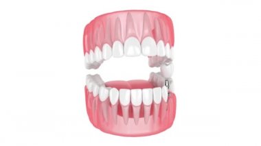 Beyaz arkaplan üzerine diş implantı yerleştirme