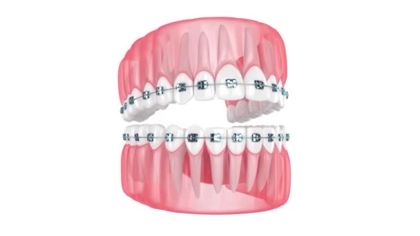 歯を持つ顎と白い背景に隔離されたステンレス製の歯列矯正ブレース — ストック動画