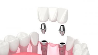 Beyaz arkaplan üzerinde diş köprüsü destekleyen implantlı çene
