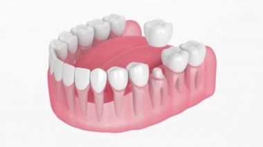 Beyaz arkaplan üzerinde yeniden şekillendirilmiş diş yerleştirilmiş diş ile çene