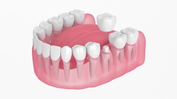 白い背景の上に歯の形をした歯冠を埋め込んだ顎 — ストック動画
