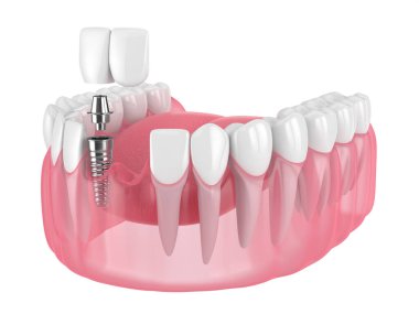 Diş kesici kantilever köprüsü implant tarafından desteklenen 3d çene oluşturucu