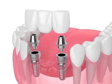 Beyaz arkaplan üzerinde diş köprüsü destekleyen implantlı çene
