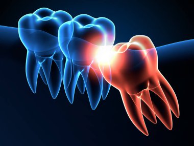 3 boyutlu çene röntgeni ve bilgelik çarpması. Farklı türde yirmilik diş sorunları kavramı.