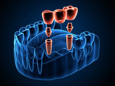 Protez destekli diş köprüsü destekli 3d çene x-ray oluşturma 