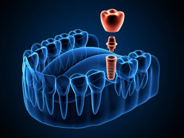 Diş implantasyonu ile çene x-ray oluşturma 3d 
