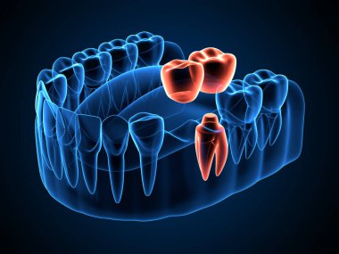 Diş kantilever köprüsü ile çene x-ray oluşturma 3d