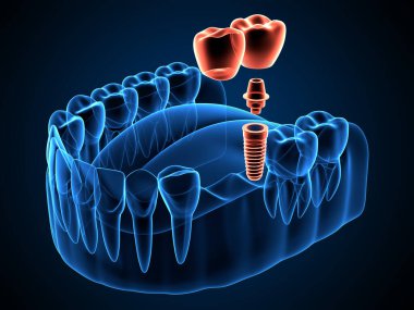 Diş kantilever köprüsü ile çene x-ray oluşturma 3d. 